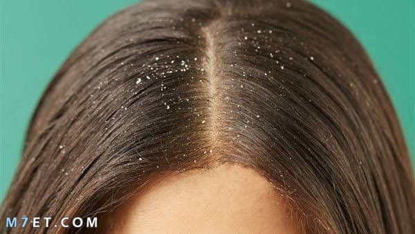 علاج القشرة في الشعر من أول مرة