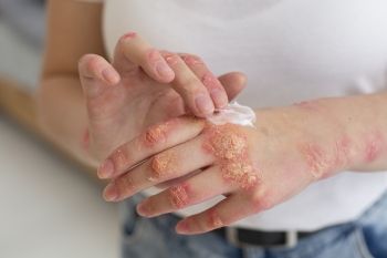 في شهرها العالمي.. مختصون: الصدفية مرض مناعي غير معد ويحتاج إلى تثقيف شامل