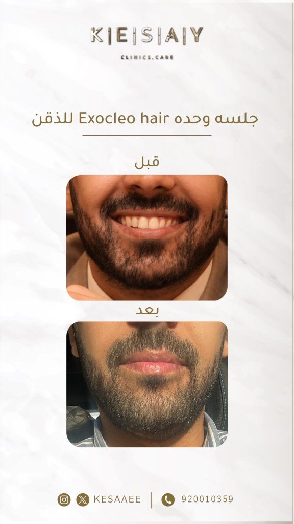 عروض اليوم الوطني 95 من عيادات الكسائي الطبية للعناية بالشعر بخصومات كبيرة 3 3 6 - عروض اليوم الوطني 95 من عيادات الكسائي الطبية للعناية بالشعر بخصومات كبيرة