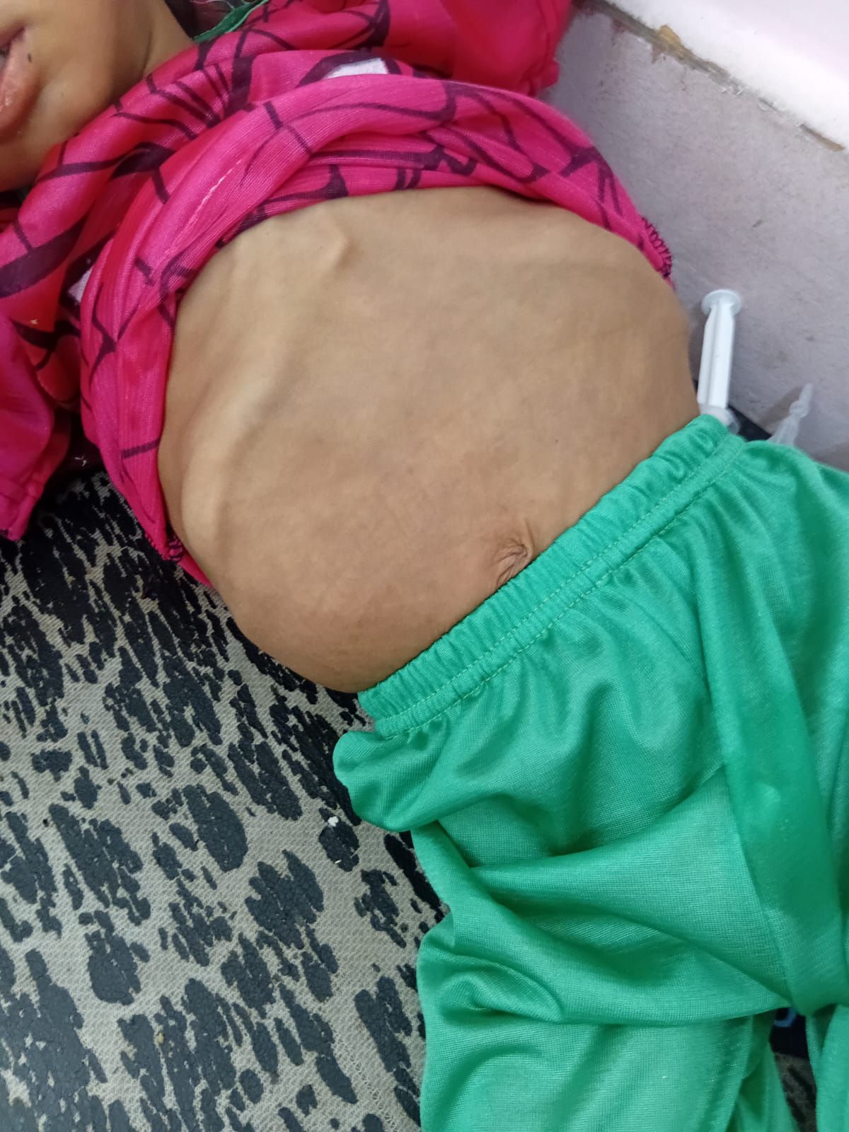 آثار المرض للطفل خليل أبو شعيرة آثار المرض للطفل خليل أبو شعيرة
