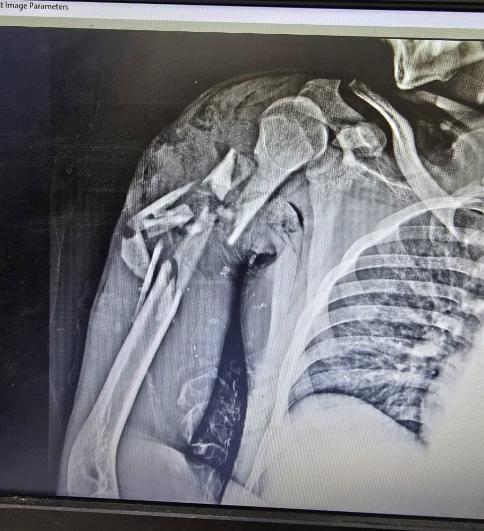 كسور بجسم الشاب بعد الحادث كسور بجسم الشاب بعد الحادث