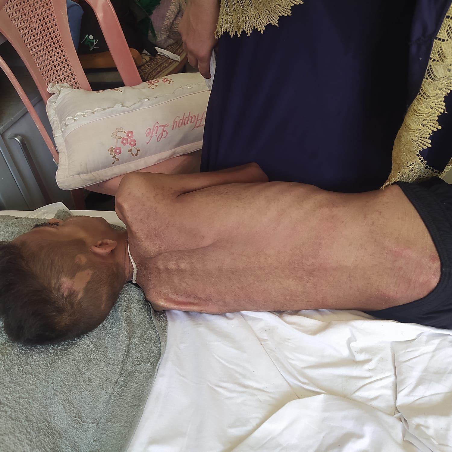 إصابات الطفل حلمى بربخ إصابات الطفل حلمى بربخ