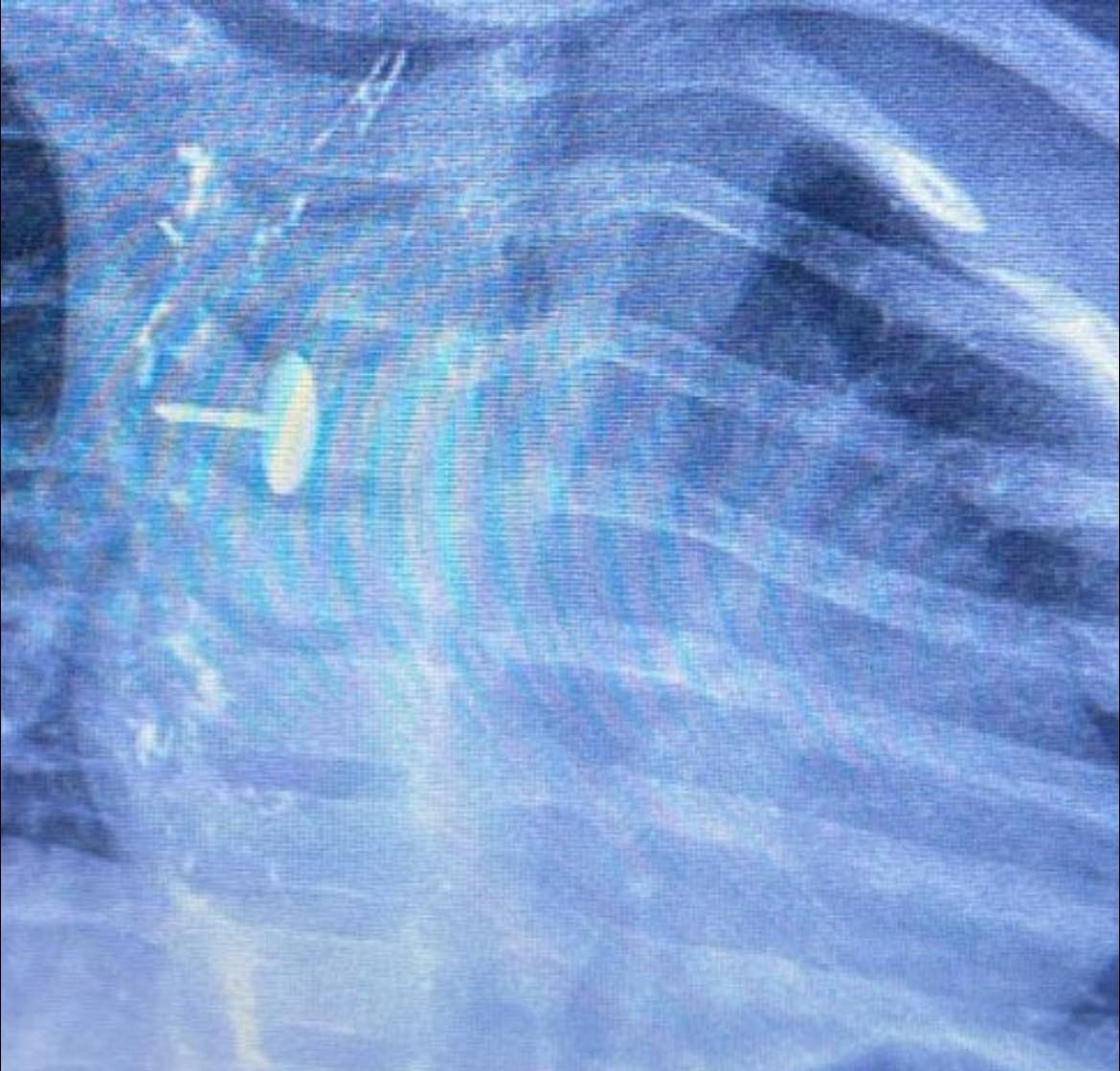 فريق جراحى بالقليوبية يستخرج دبوس ضغط من مرئ طفلة (1) فريق جراحى بالقليوبية يستخرج دبوس ضغط من مرئ طفلة (1)