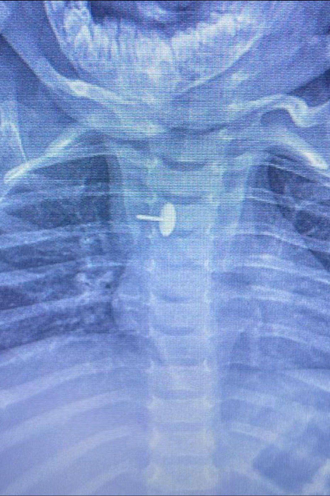 فريق جراحى بالقليوبية يستخرج دبوس ضغط من مرئ طفلة (4) فريق جراحى بالقليوبية يستخرج دبوس ضغط من مرئ طفلة (4)