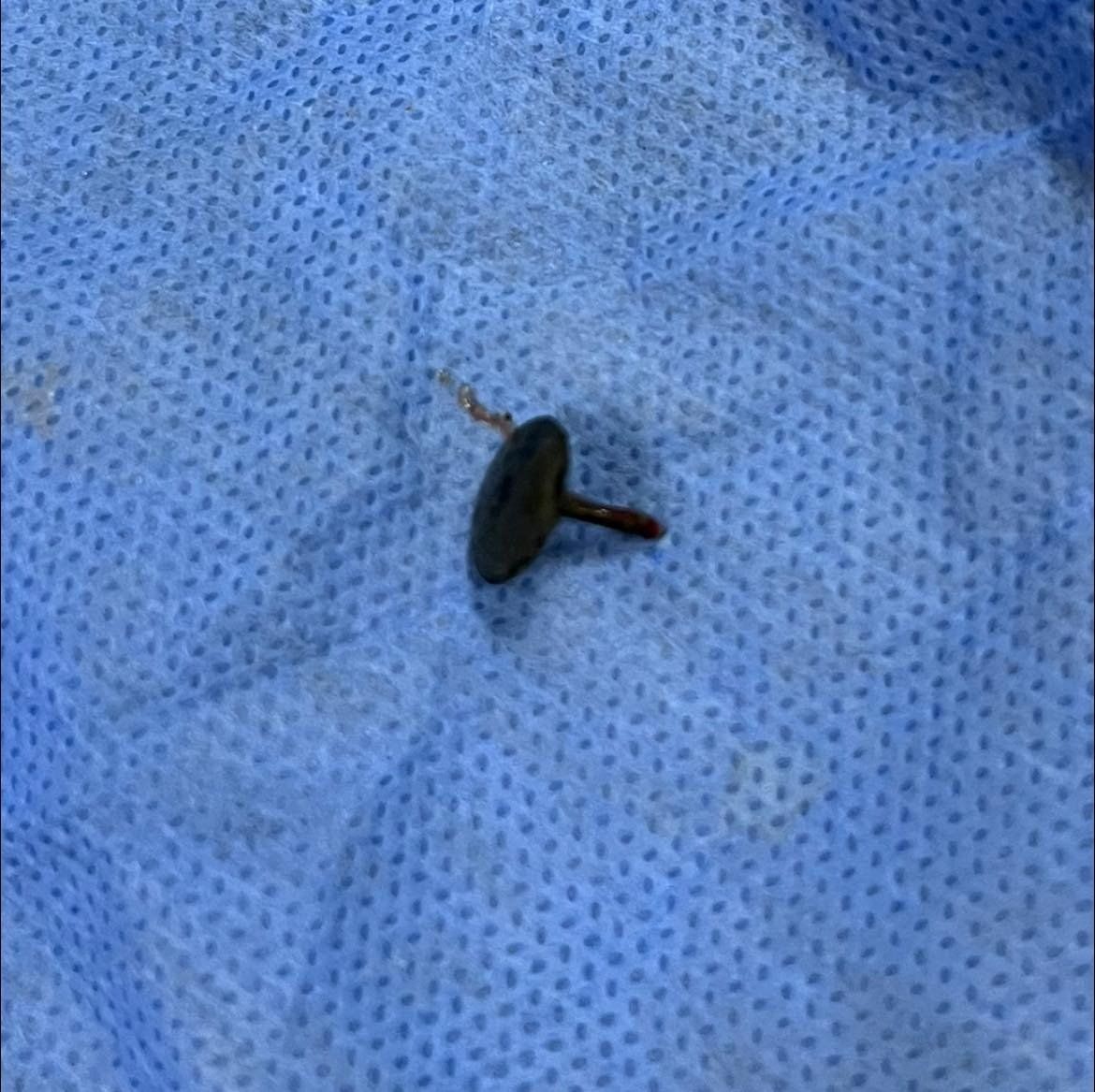 فريق جراحى بالقليوبية يستخرج دبوس ضغط من مرئ طفلة (3) فريق جراحى بالقليوبية يستخرج دبوس ضغط من مرئ طفلة (3)