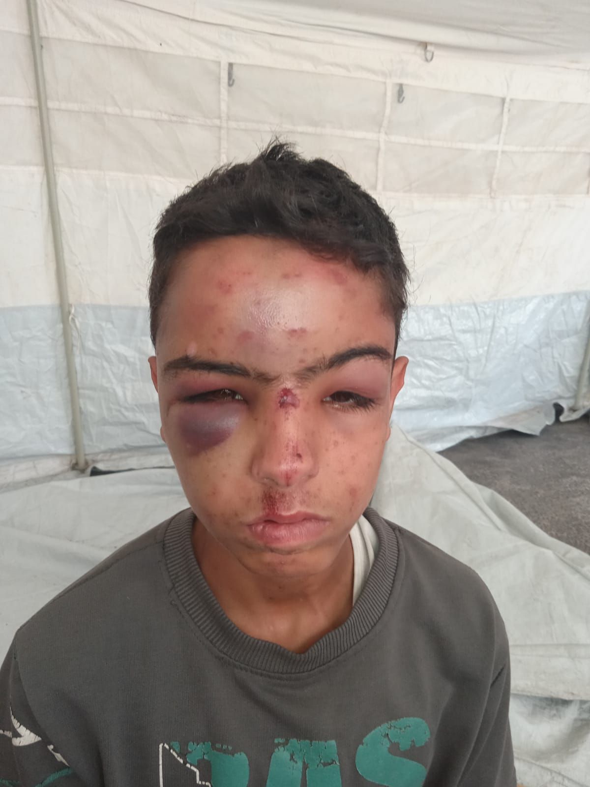 الطفل الفلسطيني المصاب عبدالله عصفور الطفل الفلسطيني المصاب عبدالله عصفور