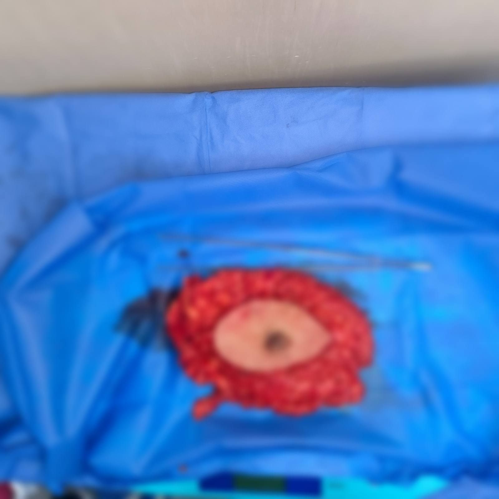 نجاح أول عملية لتقشير أورام الجهاز الهضمي (1) نجاح أول عملية لتقشير أورام الجهاز الهضمي (1)