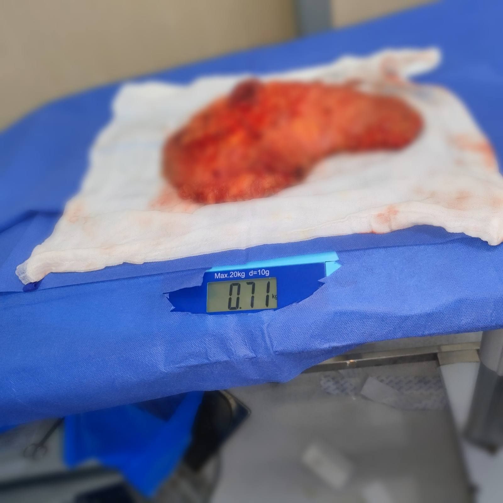 نجاح أول عملية لتقشير أورام الجهاز الهضمي (2) نجاح أول عملية لتقشير أورام الجهاز الهضمي (2)