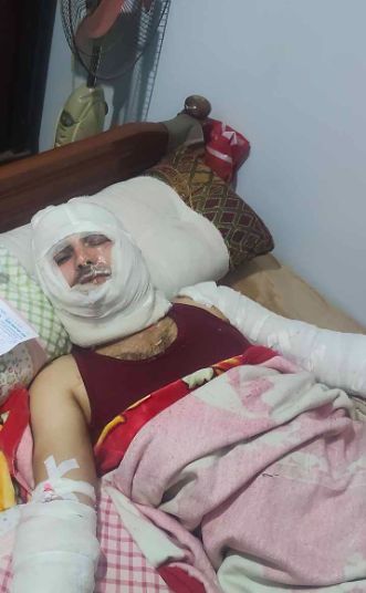 إصابة زغلول فرج الله بحروق إصابة زغلول فرج الله بحروق