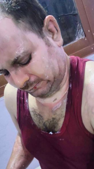 جانب من الحروق التي أصابت زغلول النجار جانب من الحروق التي أصابت زغلول النجار