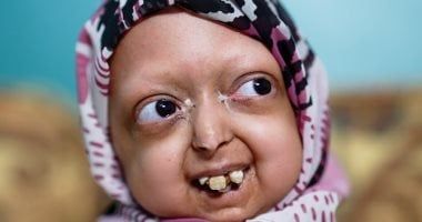 وفاة آلاء فتاة الشيخوخة وفاة آلاء فتاة الشيخوخة