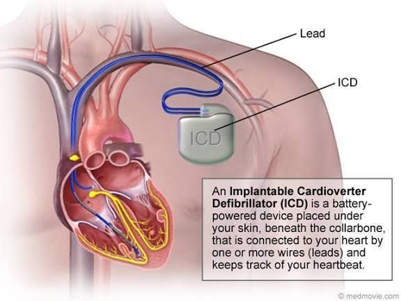 شرح لتركيب الجهاز داخل جسم المريض (1)