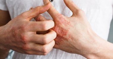 تغيرات بسيطة فى روتين الاستحمام تقلل من تفاقم إكزيما الشتاء تغيرات بسيطة فى روتين الاستحمام تقلل من تفاقم إكزيما الشتاء