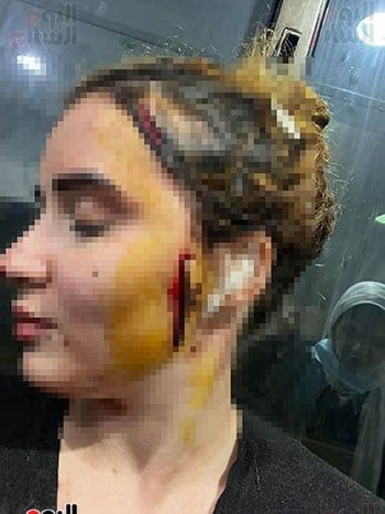 المجني-عليها-أصيبت-بـ-49-غرزة المجني-عليها-أصيبت-بـ-49-غرزة