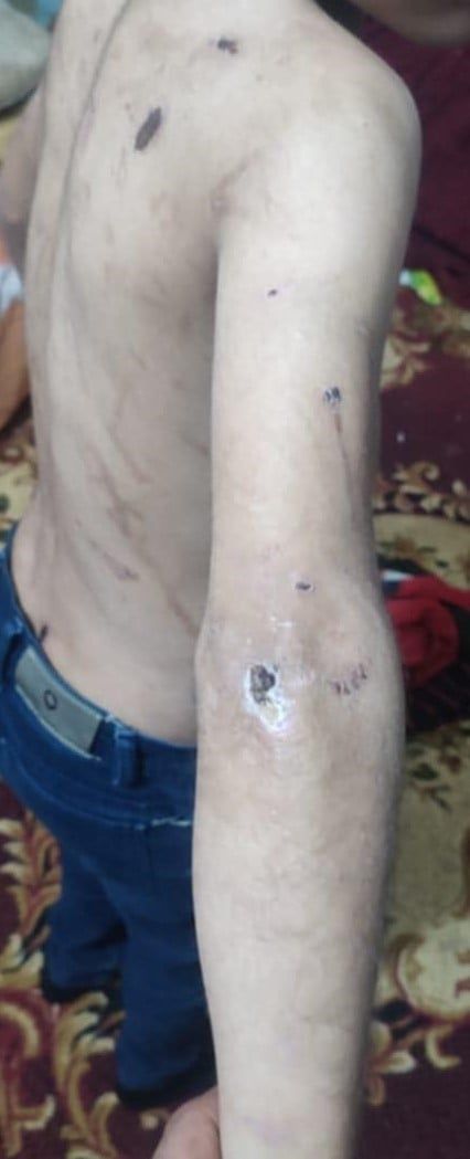 اثار التعذيب (1)