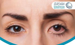 "التهاب العنبية".. حالة متغيرة النشاط و"خالد العيون" يوضح طريقة العلاج