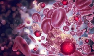 قد تكون السمنة سببًا لتطور سرطان الدم النقوي المتعدد