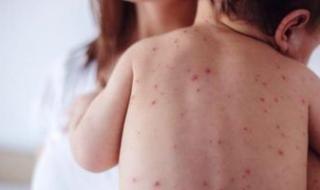 أزمة
صحية
فى
إسرائيل..
وفاة
15
طفلاً
بسبب
تفشى
الحصبة