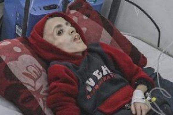 إسرائيل تقتل الطفولة.. صور الطفل يزن الكفارنة تدمى القلب بعد وفاته من الجوع