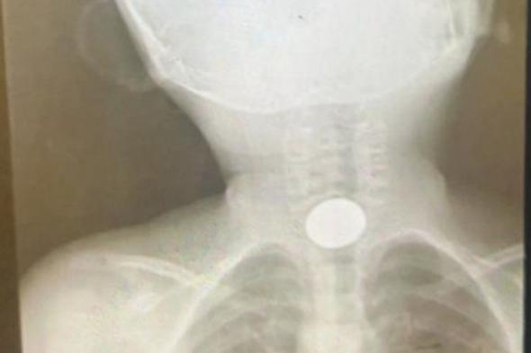 تدخّل عاجل بـ"سعود الطبية" ينقذ حياة طفلة ابتلعت عملة معدنية عَلِقَت بالبلعوم
