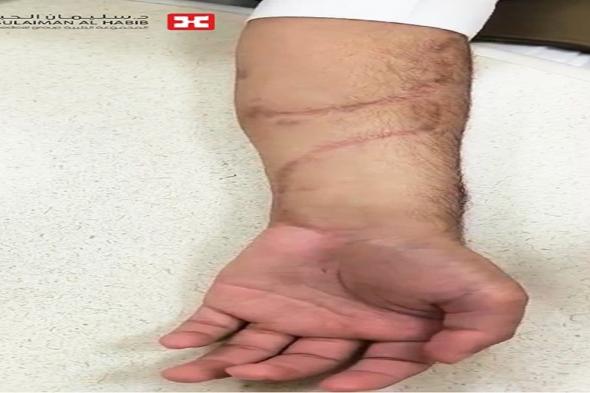 مستشفى الدكتور سليمان الحبيب بالريان يُنقذ عشريني من بتر ذراعه نتيجة لحادث سير
