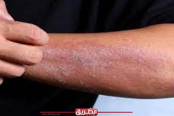 ما هي الأمراض الجلدية الصيفية وكيفية الوقاية منها؟اليوم الأربعاء، 15 مايو 2024 09:58 صـ