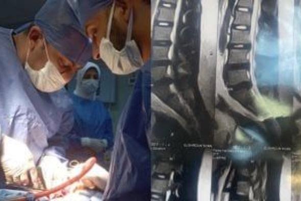 صحة الدقهلية: نجاح جراحة دقيقة بمستشفى تمى الأمديد فى إنقاذ شاب من الشلل