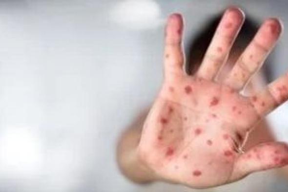 الصحة العالمية تصدر إرشادات جديدة للوقاية من جدرى القرود