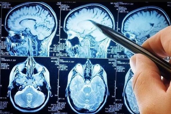 الاضطرابات النفسية تسرع الإصابة بالخرف بنسبة 90%