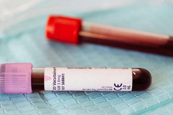 دراسة دولية: اختلاف نتائج اختبارات وظائف الكلى يُنذر بمخاطر صحية