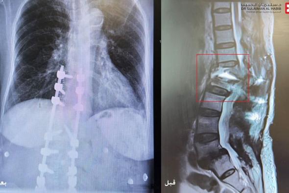 مستشفى الدكتور سليمان الحبيب بالخبر يُعيد قدرة المشي لسبعينية أصيبت بتشوه بالعمود الفقري نتيجة "5" عمليات سابقة غير ناجحة