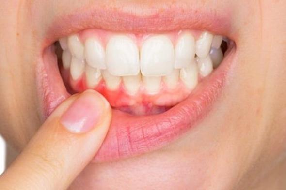 التهابات الفم والمادة البيضاء.. دراسة تحذر: أمراض اللثة قد ترتبط بالسكتة الدماغية والضعف الإدراكي