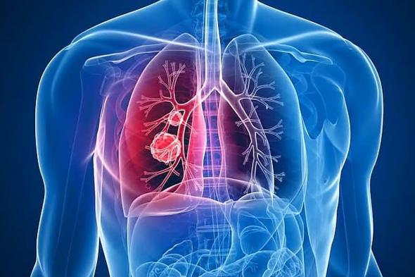 وزارة الصحة: 9 أعراض للإلتهاب الرئوي لدى الأطفال