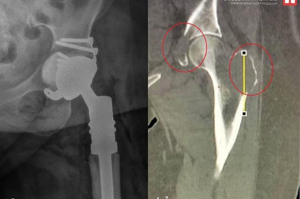 مستشفى الدكتور سليمان الحبيب بالمحمدية في جدة يُنهي معاناة خمسينية مع ورم سرطاني بعظمة الفخذ