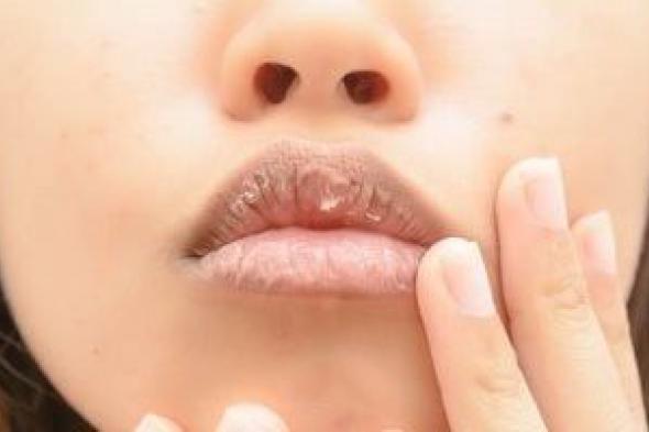 تشقق
الشفاه
انتبه
لأسبابه
المرضية
متعددة