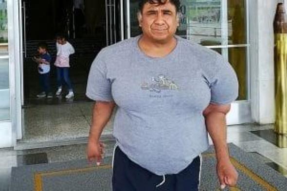 جسمه
شبه
البلونة..
حادث
غوص
يصيب
رجل
بيروفى
بمرض
نادر
يعجز
الأطباء
عن
علاجه