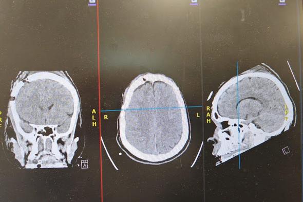 إنقاذ
    حياة
    شاب
    تعرّض
    لنزيف
    حاد
    في
    الدماغ
    إثر
    حادث
    مروري
    بمستشفى
    الأمير
    عبدالمحسن
    بالعلا