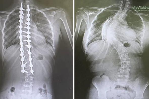 مستشفى
    الدكتور
    سليمان
    الحبيب
    بالقصيم
    يجرى
    عملية
    ناجحة
    لتقويم
    "جنف"
    بزاوية
    "95"
    درجة
