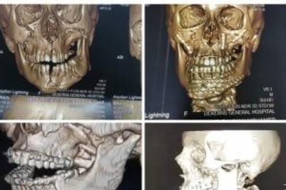 نجاح
الفريق
الطبي
بمستشفى
دكرنس
العام
فى
إنقاذ
طفل
من
تهشم
كامل
بالوجه