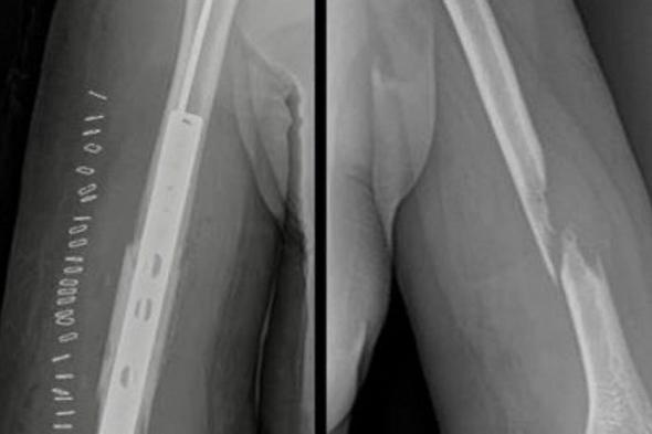 إعادة
    حركة
    يد
    خمسينية
    بعد
    جراحة
    دقيقة
    لأورام
    العظام
    في
    المدينة
