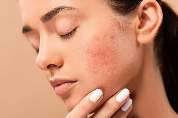 تجمع
    القصيم
    يوضح
    أسباب
    الإصابة
    بمتلازمة
    الجلد
    المُحمّص
    وطرق
    الوقاية
    منها