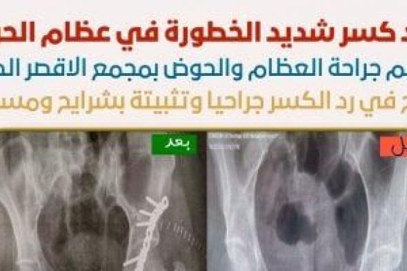 أطباء
مجمع
الأقصر
الطبي
ينجحون
فى
رد
مفتوح
لكسر
خطير
بعظام
الحوض
لمواطن