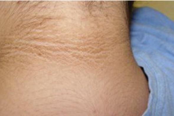 البقع
الداكنة
على
الجلد
علامة
على
مقاومة
الأنسولين