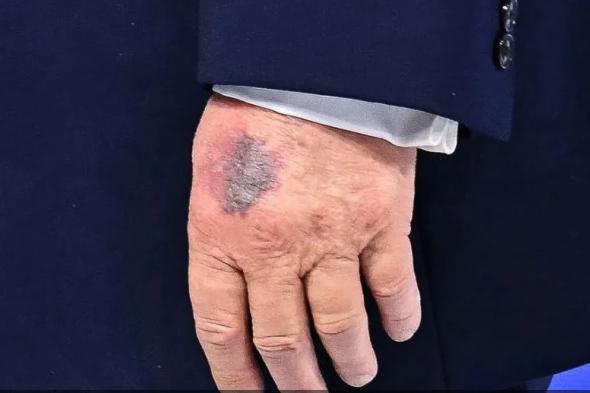 ترامب يكشف سبب الكدمة على يده: طاولة السلام