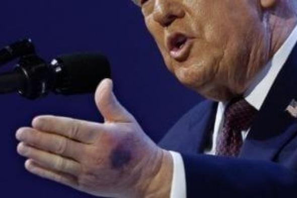 البيت
الأبيض
يكشف
سبب
كدمة
على
يد
الرئيس
الأمريكى
ترامب
فى
دافوس..
صور