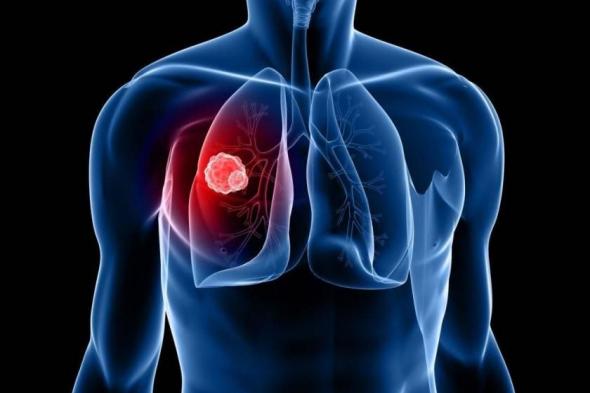 العثور
      على
      «درع
      خفي»
      لخلايا
      سرطان
      الرئة