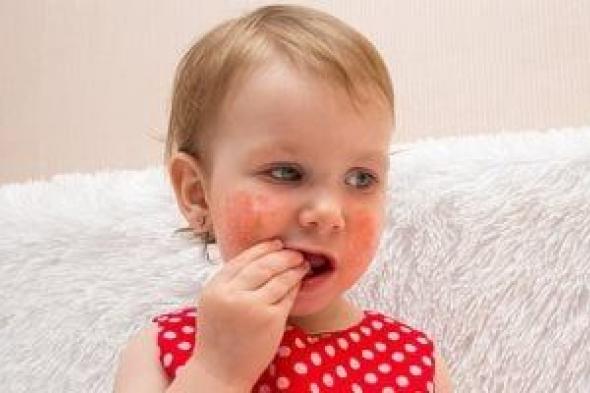 روشتة
سهلة
لحماية
طفلك
من
الحساسية
الغذائية