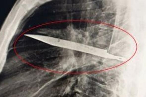 النيابة
تستعلم
عن
الحالة
الصحية
للمجنى
عليه
فى
واقعة
طعن
زوجته
له
بأكتوبر