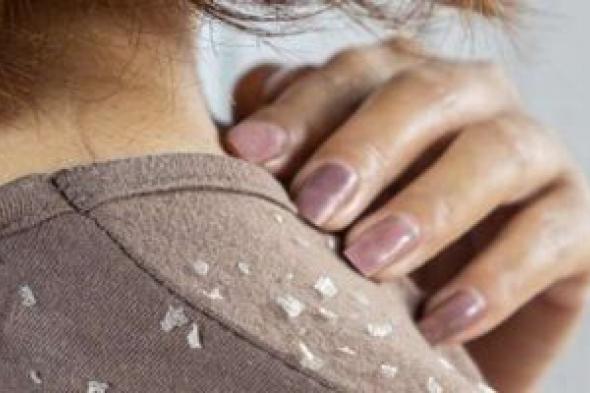 أسباب
قشرة
الشعر
وطرق
العلاج..
متى
تذهب
للطبيب